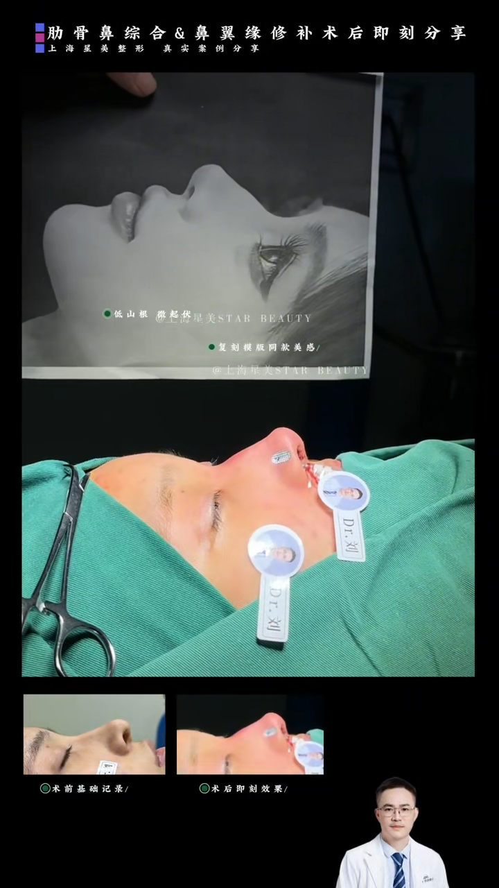 Immediate case after rib-nose synthesis + nasal flap repair: a combined plan of "nasal tip support + nasal flap reduction"