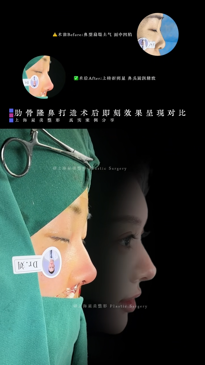 Comparison of immediate effects after rib augmentation rhinoplasty