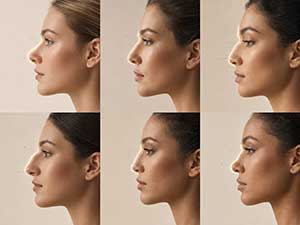 Correction plans for six types of nasal deformities