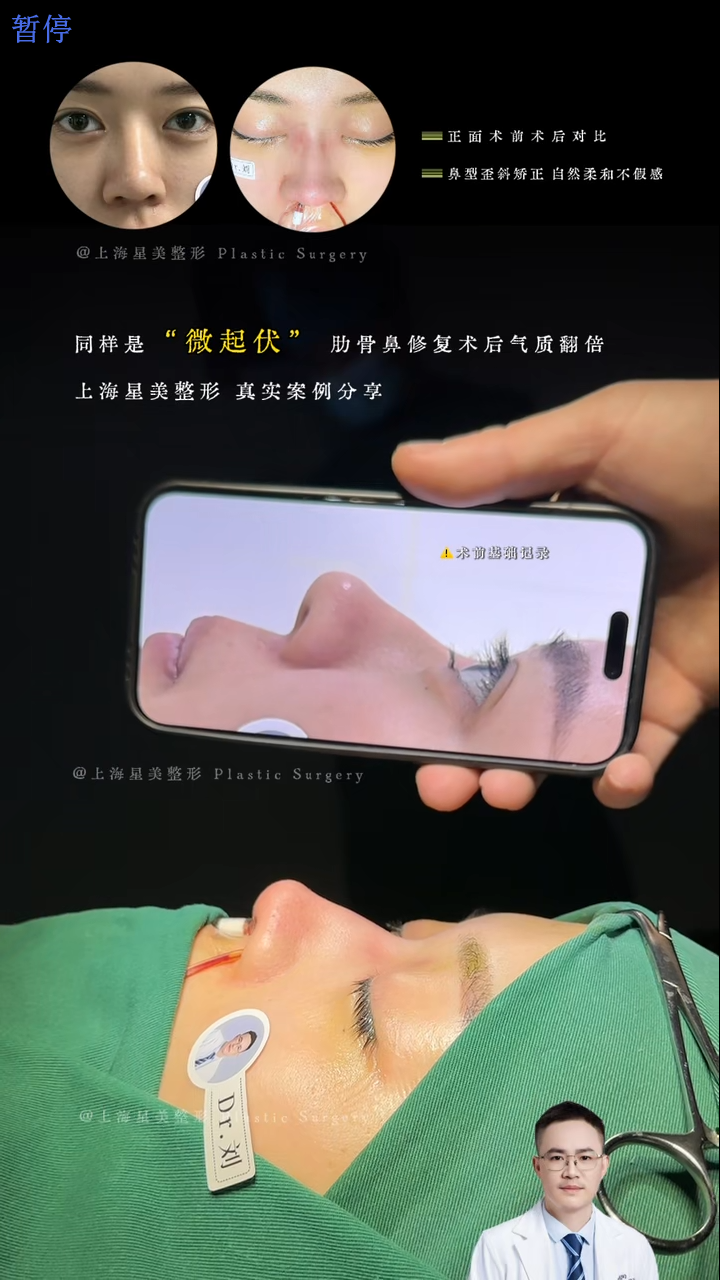 Micro-undulating rib nose repair