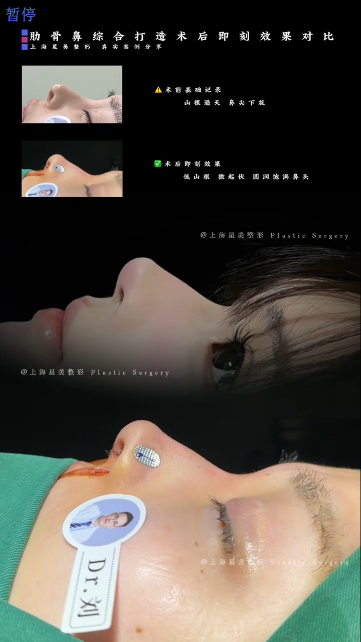 Immediate comparison after rib-nose synthesis